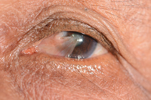 Closeup of an Eye With Pteryguim